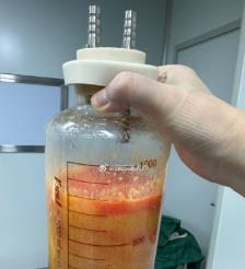 凤城水动力吸脂手术要做多久？